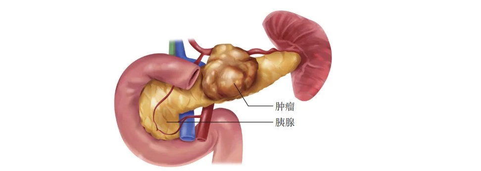 胰腺癌为何被称癌中之王