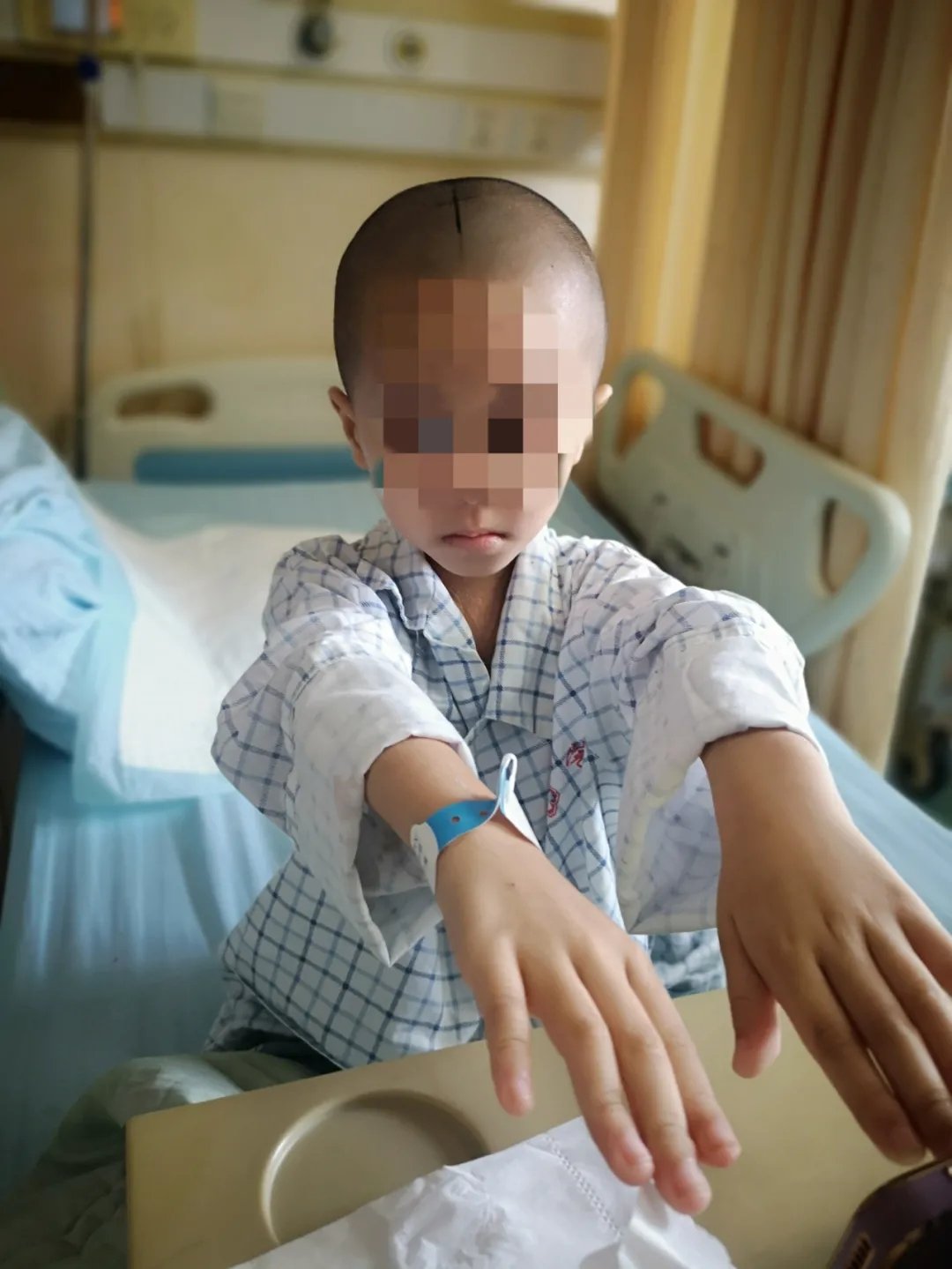 幼童颅内生巨瘤 神外巧手除顽疾